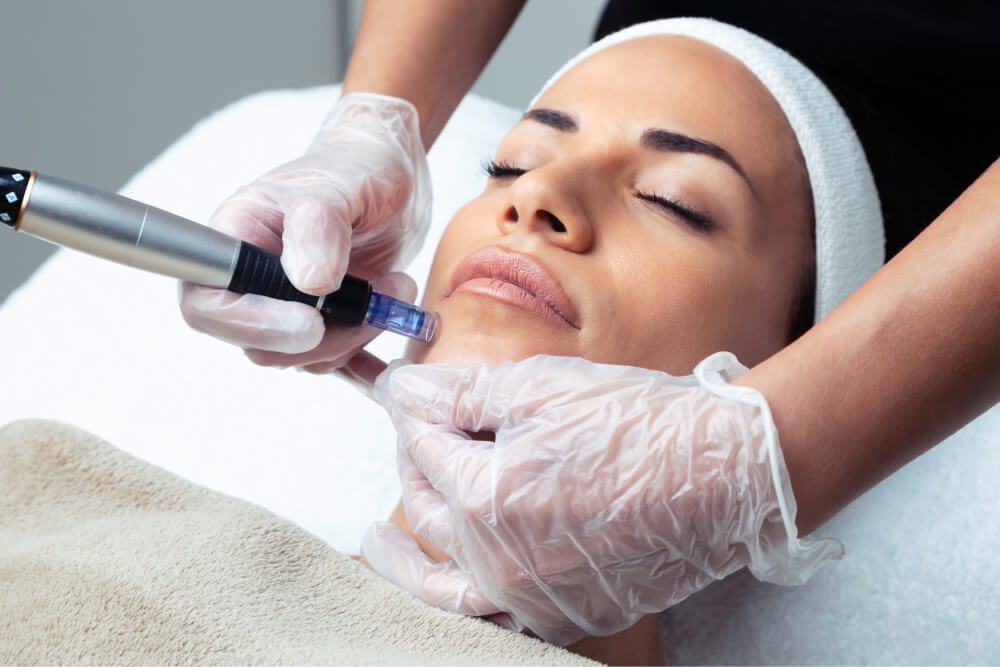 The Science Behind Microneedling: Rejuvenating Your Skin From Within